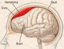 Race car drivers death: subdural hematoma as a cause